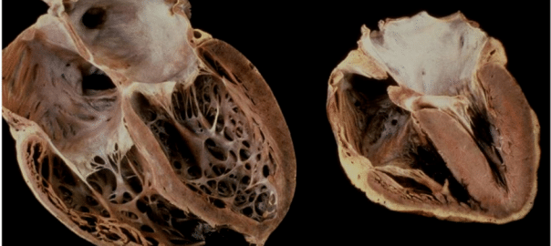 Tout sur la myocardiopathie alcoolique : une revue de littérature publiée dans ACER