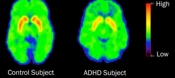 Contribution des études de neuro-imagerie à la compréhension du mode d’action pharmacologique du méthylphénidate : un article de synthèse paru dans la revue Trends in Pharmacological Sciences